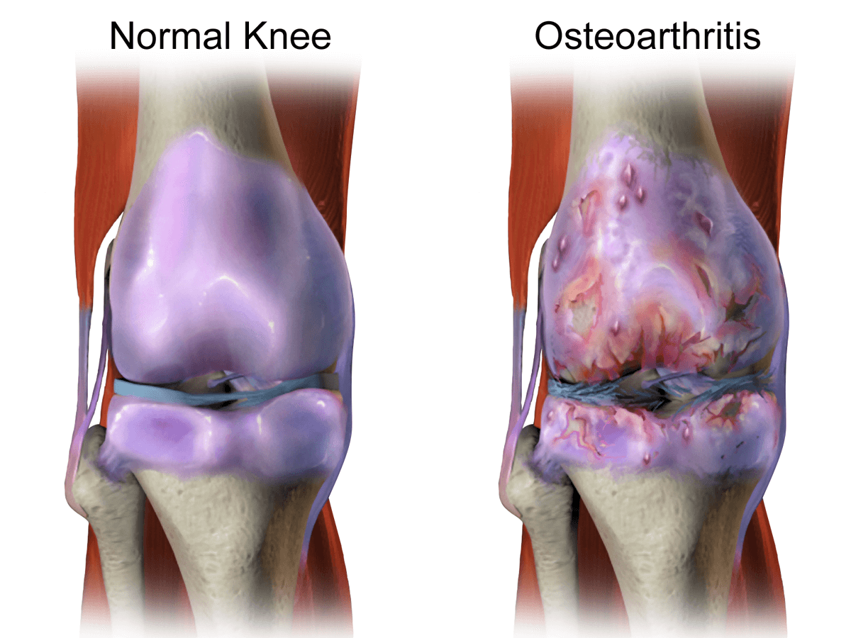 ostheoarthritis-pain